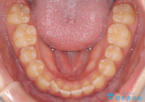 【インビザライン】がたつきをマウスピースできれいにしたいの治療前