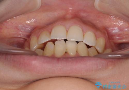 後戻りの再矯正 ワイヤー装置でデコボコと隙間を改善の治療後