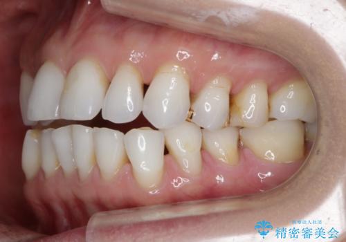 【非抜歯】マウスピースでオープンバイトを治すの治療前