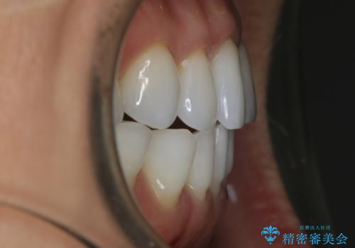【非抜歯】マウスピースでオープンバイトを治すの治療後