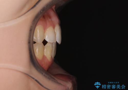 後戻りの再矯正 ワイヤー装置でデコボコと隙間を改善の治療後