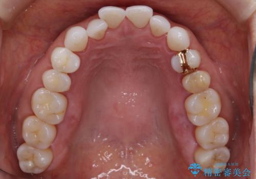 【非抜歯】マウスピースでオープンバイトを治すの治療前