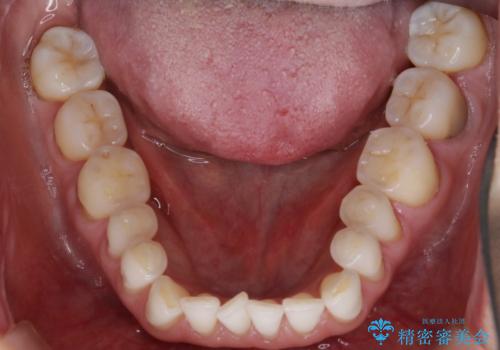 【非抜歯】マウスピースでオープンバイトを治すの治療前