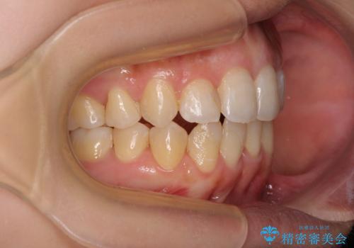 後戻りの再矯正 ワイヤー装置でデコボコと隙間を改善の治療後