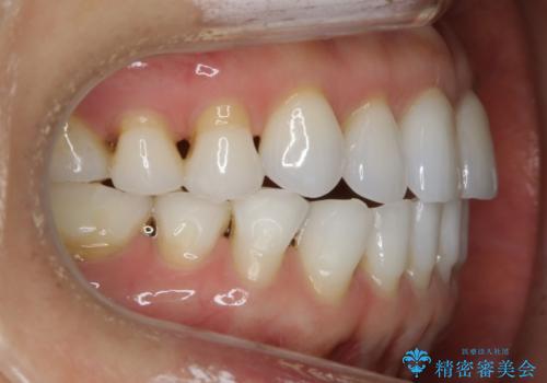 【非抜歯】マウスピースでオープンバイトを治すの治療後