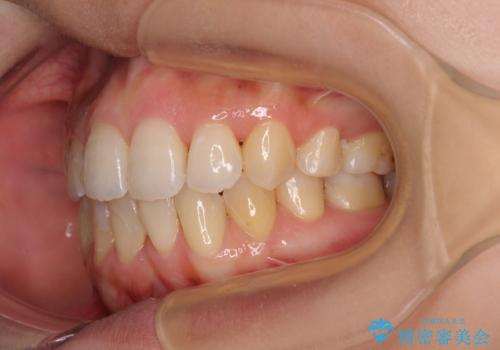 後戻りの再矯正 ワイヤー装置でデコボコと隙間を改善の治療後