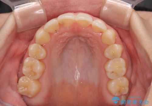 後戻りの再矯正 ワイヤー装置でデコボコと隙間を改善の治療後
