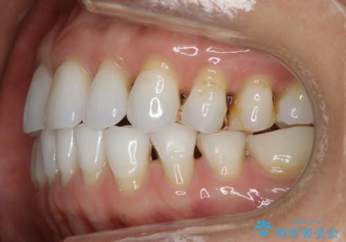 【非抜歯】マウスピースでオープンバイトを治すの治療後