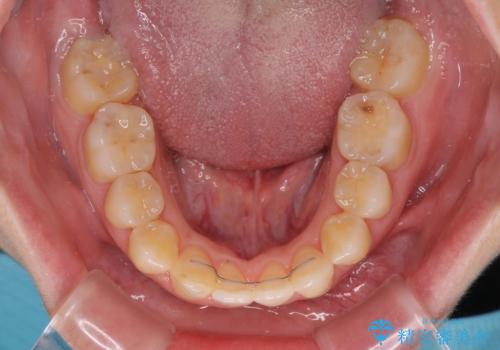 後戻りの再矯正 ワイヤー装置でデコボコと隙間を改善の治療後