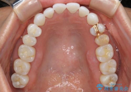【非抜歯】マウスピースでオープンバイトを治すの治療後