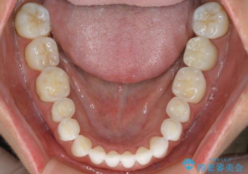 【非抜歯】マウスピースでオープンバイトを治すの治療後