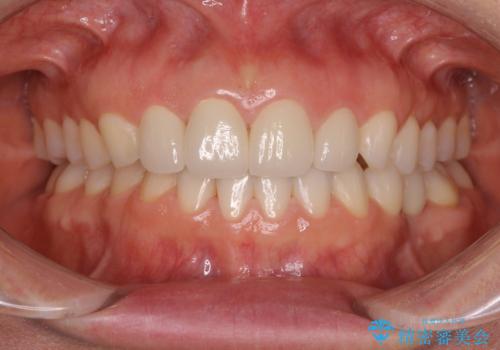 前歯を綺麗にしたい　部分矯正とセラミック治療