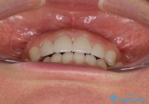 前歯を綺麗にしたい 部分矯正とセラミック治療の治療後