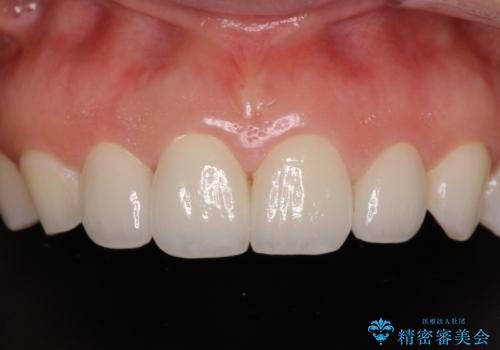 前歯を綺麗にしたい　部分矯正とセラミック治療の治療後