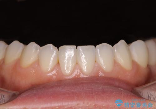 前歯を綺麗にしたい 部分矯正とセラミック治療の治療後