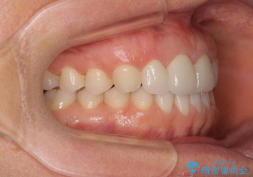 前歯を綺麗にしたい　部分矯正とセラミック治療の治療後