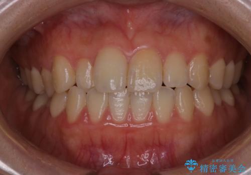 【インビザライン】前歯のがたつきを目立たない装置で治療の症例 治療前