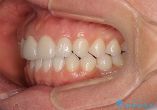 前歯を綺麗にしたい 部分矯正とセラミック治療の治療後