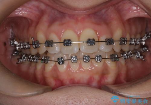 【ワイヤー矯正】前歯のがたつきを短期間で治したいの治療中