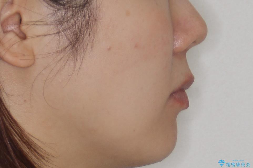 【審美装置】前歯のがたがたを治したいの治療前(顔貌)