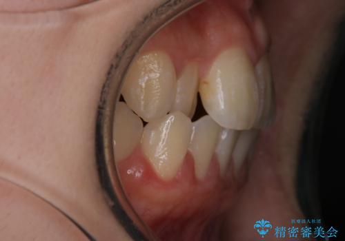 【インビザライン】前歯のがたつきを目立たない装置で治療の治療前