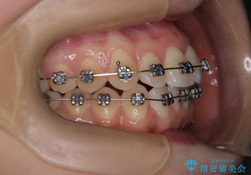 【ワイヤー矯正】前歯のがたつきを短期間で治したいの治療中
