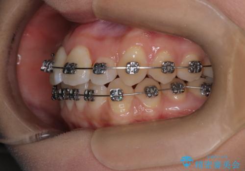 【ワイヤー矯正】前歯のがたつきを短期間で治したいの治療中