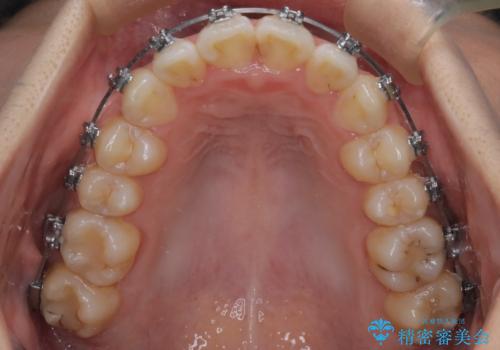 【ワイヤー矯正】前歯のがたつきを短期間で治したいの治療中