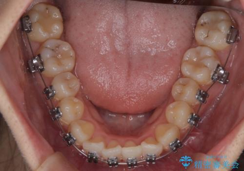 【ワイヤー矯正】前歯のがたつきを短期間で治したいの治療中
