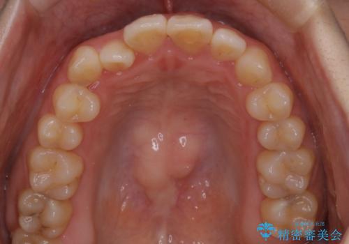 【インビザライン】前歯のがたつきを目立たない装置で治療の治療前