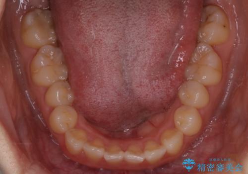 【インビザライン】前歯のがたつきを目立たない装置で治療の治療前