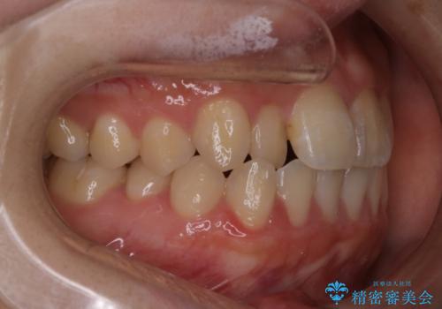 【インビザライン】前歯のがたつきを目立たない装置で治療の治療前