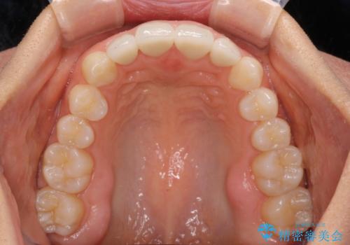 前歯を綺麗にしたい 部分矯正とセラミック治療の治療後