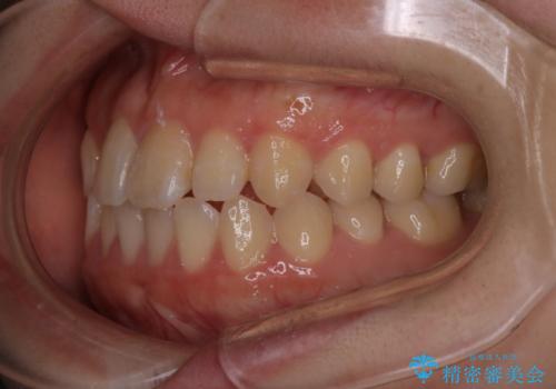 【インビザライン】前歯のがたつきを目立たない装置で治療の治療前