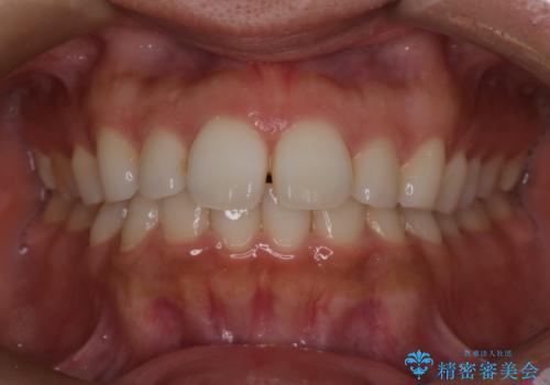 【インビザライン】前歯の後戻りを再矯正の症例 治療前