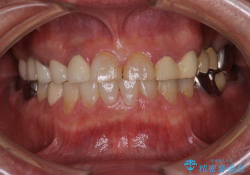 歯肉からの出血 適合の悪い銀歯をオールセラミックのブリッジにやり替えの治療後