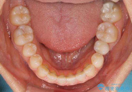 前歯を綺麗にしたい 部分矯正とセラミック治療の治療後