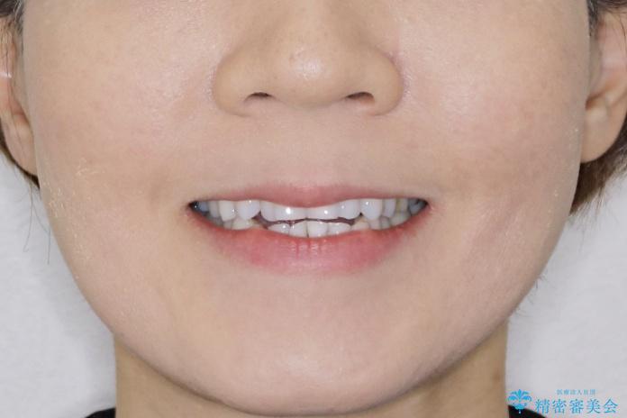 【非抜歯】マウスピースでオープンバイトを治すの治療前(顔貌)