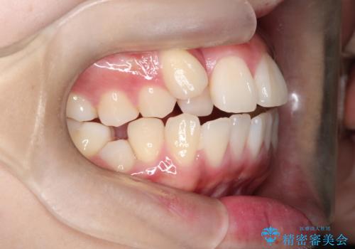 【ワイヤー矯正】オープンバイトを治したいの治療前