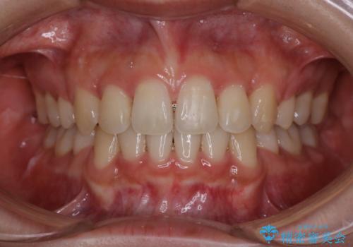 【審美装置】抜歯矯正で口元を改善の症例 治療後