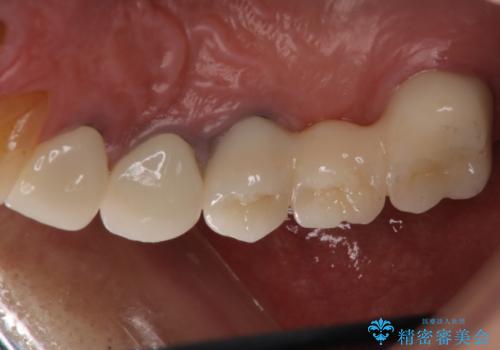 歯肉からの出血 適合の悪い銀歯をオールセラミックのブリッジにやり替えの治療後