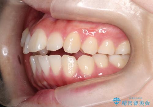 【ワイヤー矯正】オープンバイトを治したいの治療前