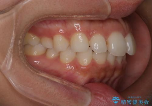 【インビザライン】前歯の後戻りを再矯正の治療前