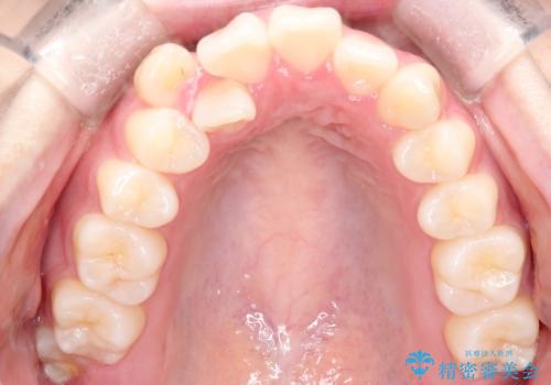 【ワイヤー矯正】オープンバイトを治したいの治療前