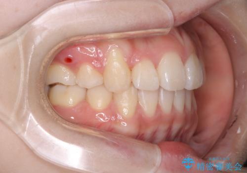 【ワイヤー矯正】オープンバイトを治したいの治療後