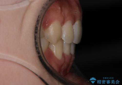 【審美装置】抜歯矯正で口元を改善の治療後