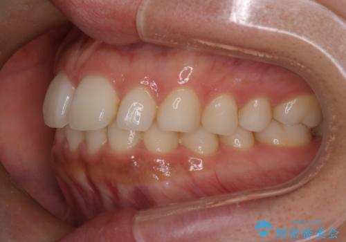 【インビザライン】前歯の後戻りを再矯正の治療前