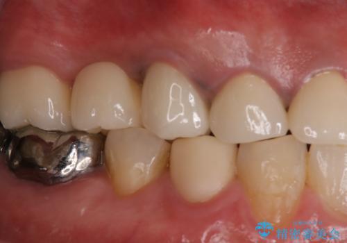 歯肉からの出血 適合の悪い銀歯をオールセラミックのブリッジにやり替えの治療後