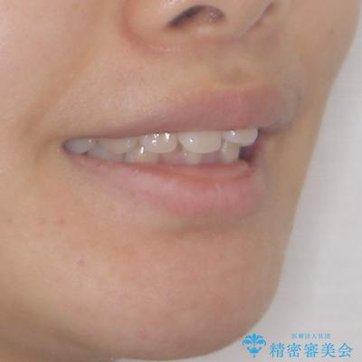 飛び出した上顎前歯 ワイヤー装置にて抜歯矯正治療の治療前(顔貌)