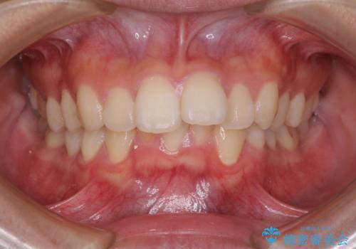 飛び出した上顎前歯 ワイヤー装置にて抜歯矯正治療の症例 治療前